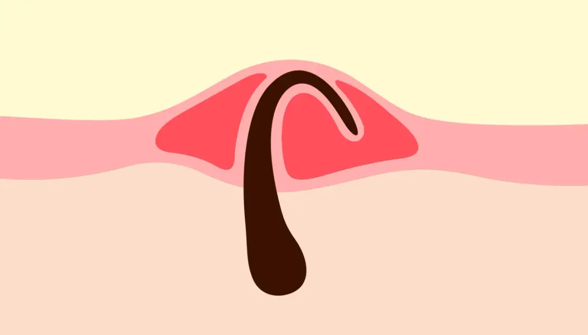 Illustration d'un poil incarné sous la peau, avec une partie sombre courbée sous une couche rouge.