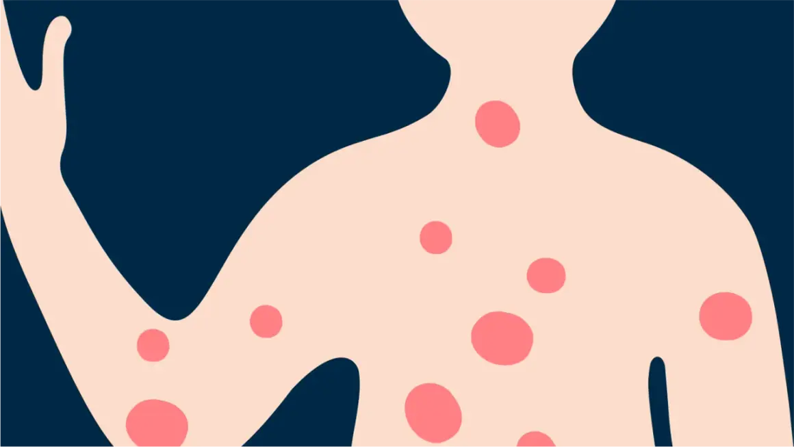 Illustration d'un torse et d'un bras avec des plaques rouges, évoquant l'eczéma sur le dos et le corps.