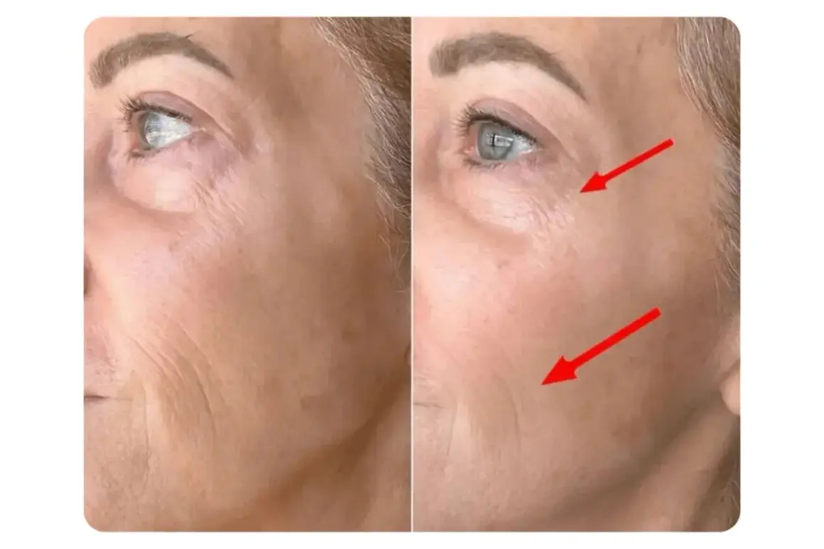 Avant/après : le masque LED a réduit les rides du visage, comme indiqué par les flèches rouges.