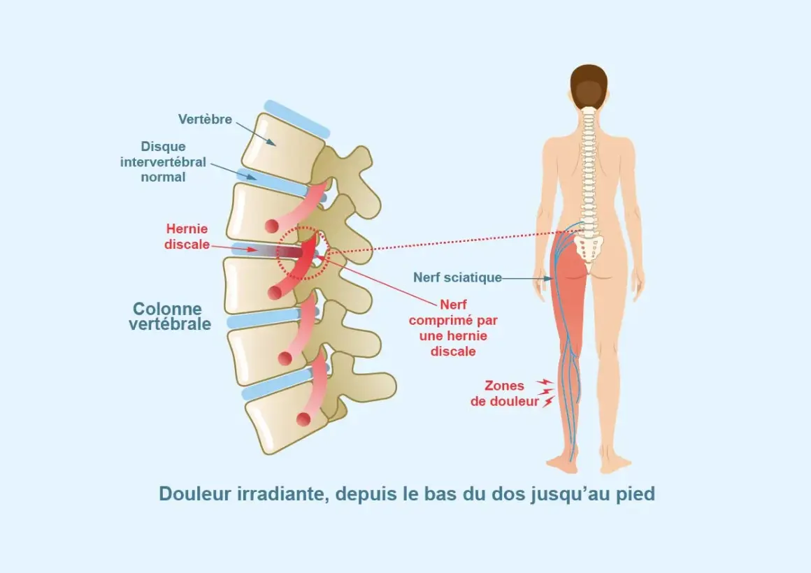 Schéma montrant une hernie discale comprimant le nerf sciatique, causant douleur irradiante dans le muscle fessier et la jambe.