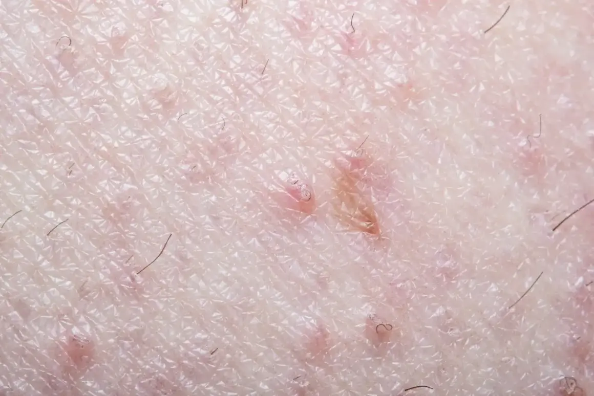 Gros plan sur la peau du pubis, montrant des rougeurs et des poils incarnés, signe d'une irritation cutanée.
