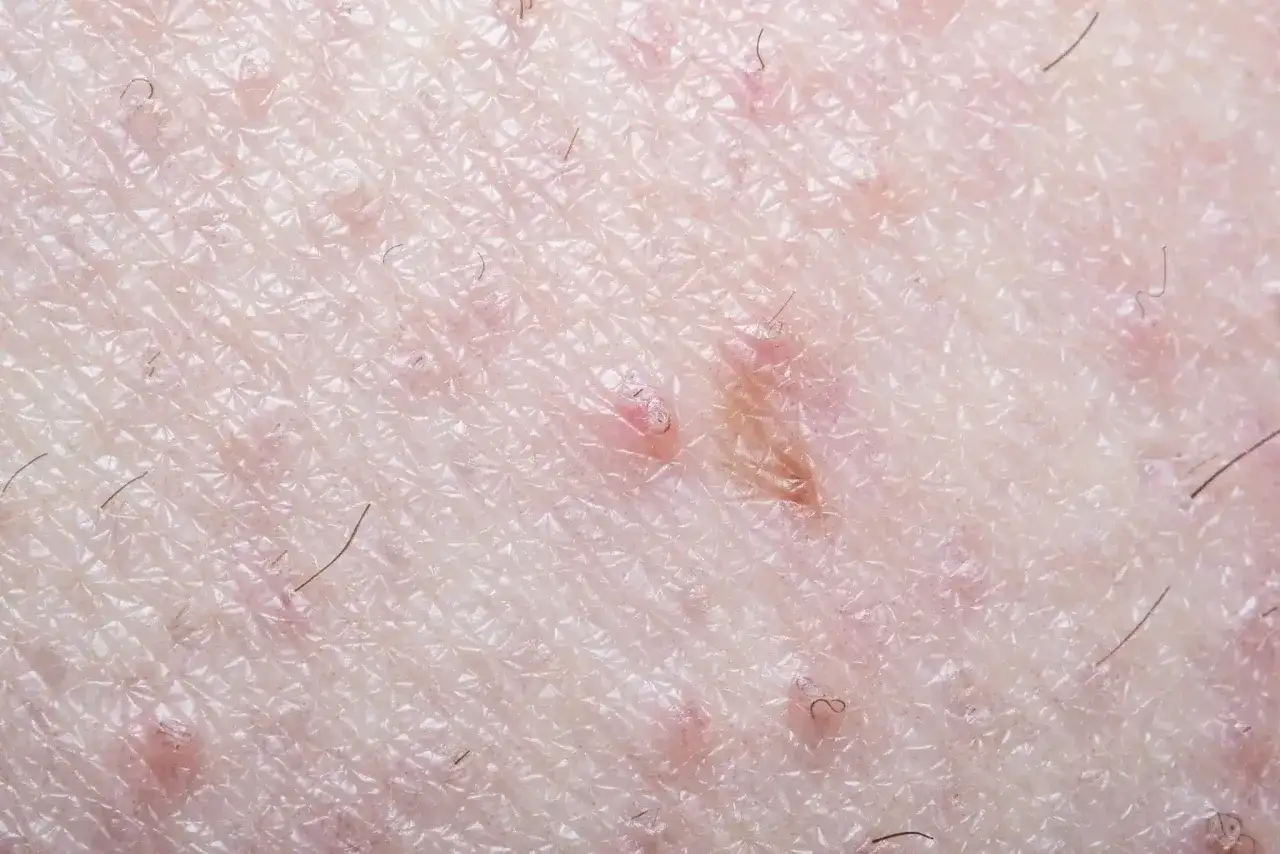 Poil incarné au pubis - comment le reconnaître et le calmer