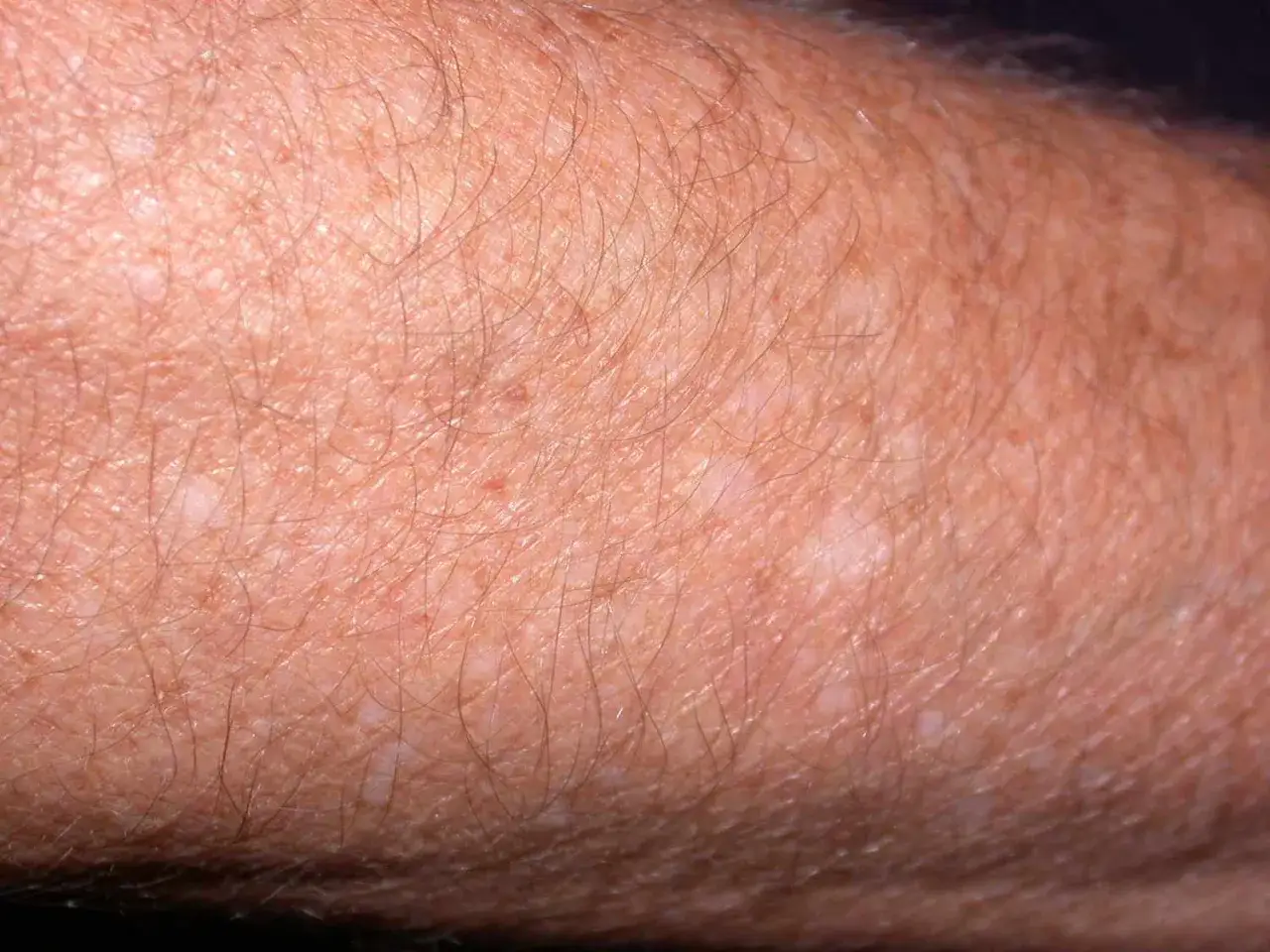 Gros plan sur un bras humain montrant des taches blanches sur la peau, probablement dues à une exposition au soleil. La peau est légèrement poilue.