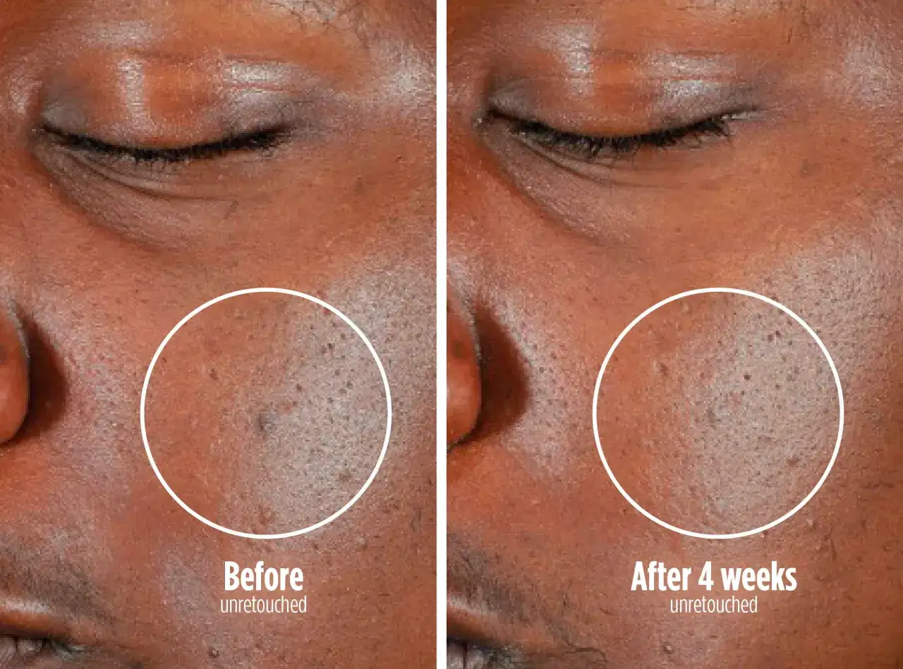 Comparaison avant/apr&egrave;s d'un masque LED visage : la peau semble plus lisse et les pores moins visibles apr&egrave;s 4 semaines.