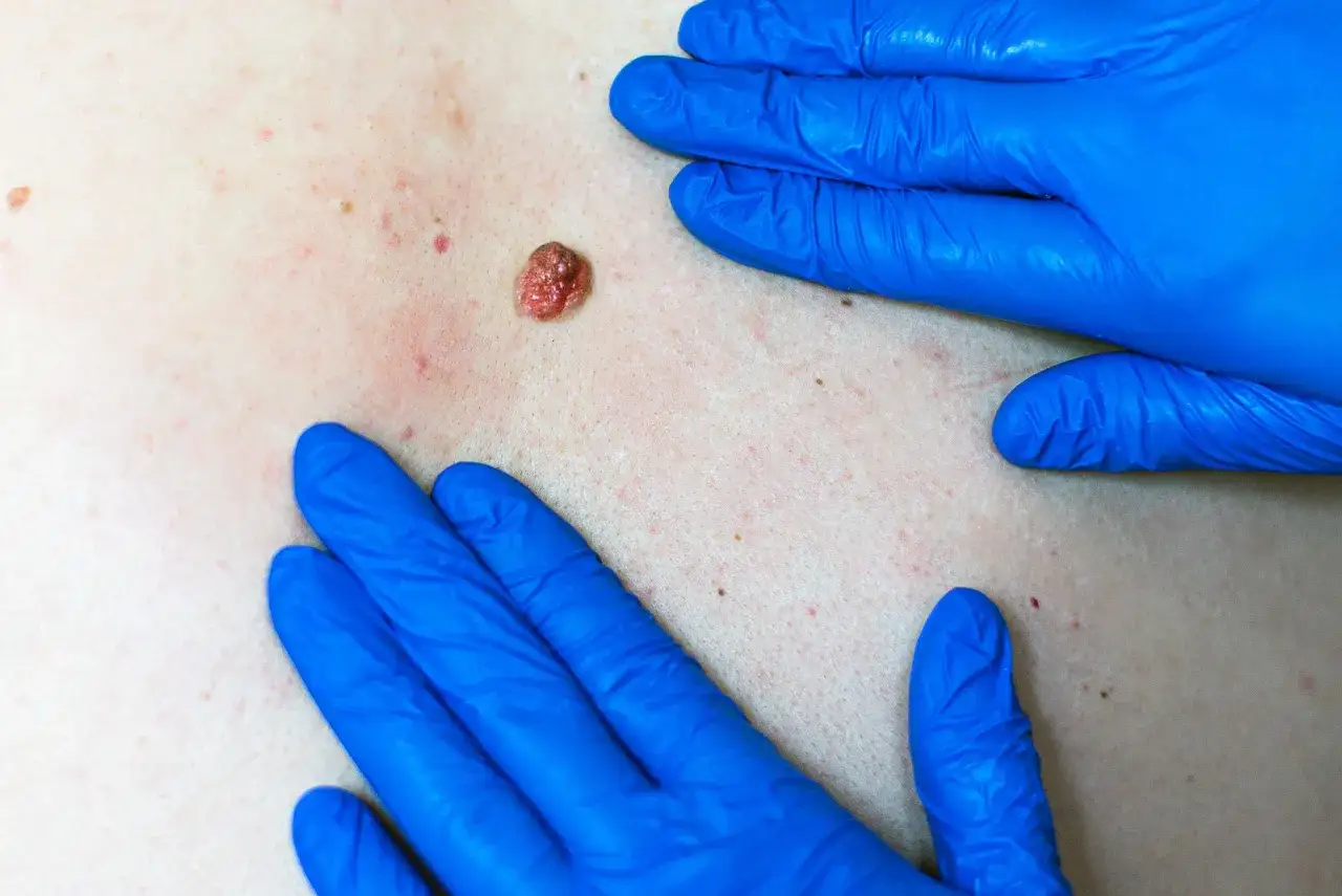 Gros plan sur un bouton qui ne part pas sur la peau, examin&eacute; par des mains gant&eacute;es de bleu.