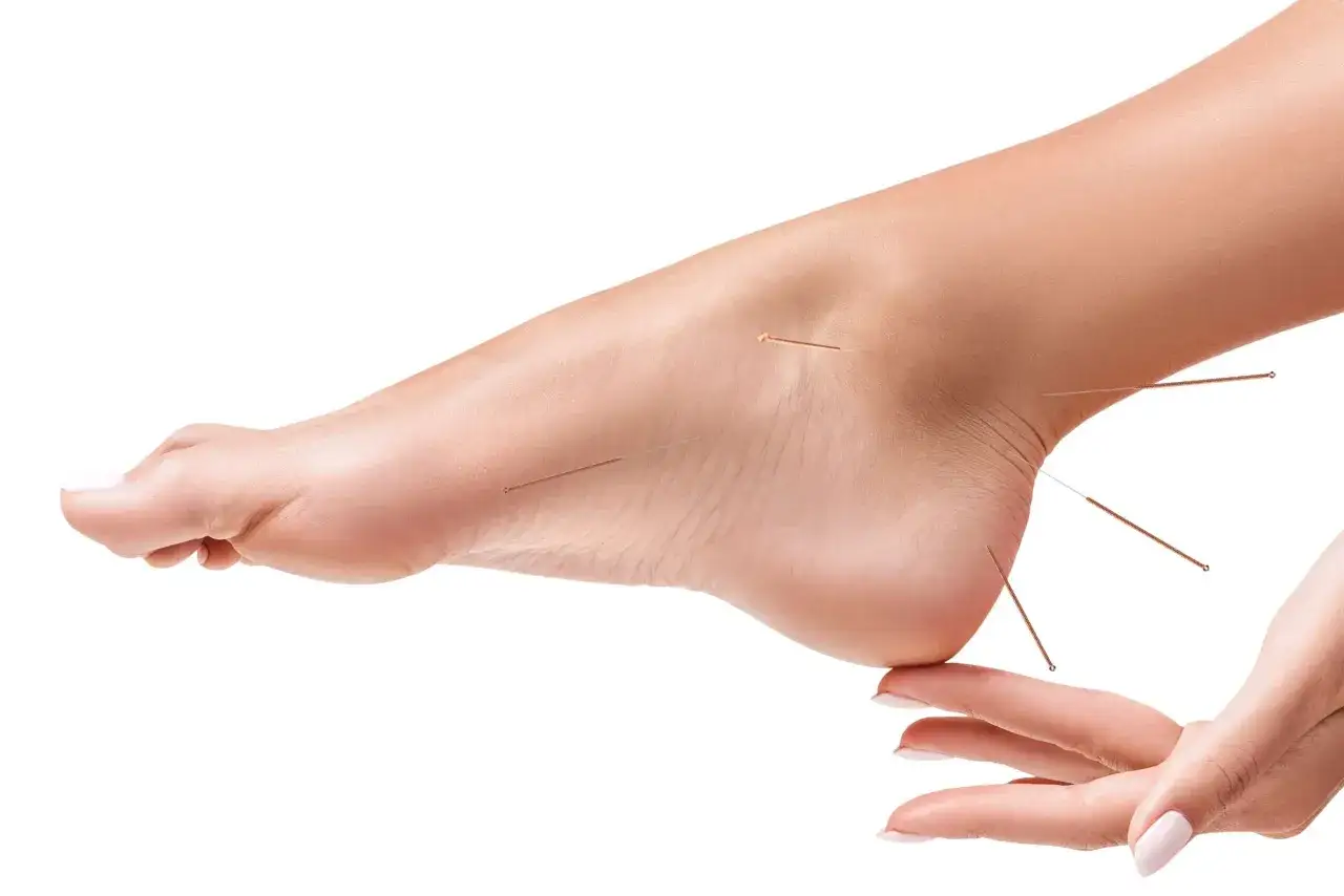 Acupuncture sur le pied pour soulager la douleur. Des aiguilles fines sont ins&eacute;r&eacute;es sur le dessus et le talon du pied.