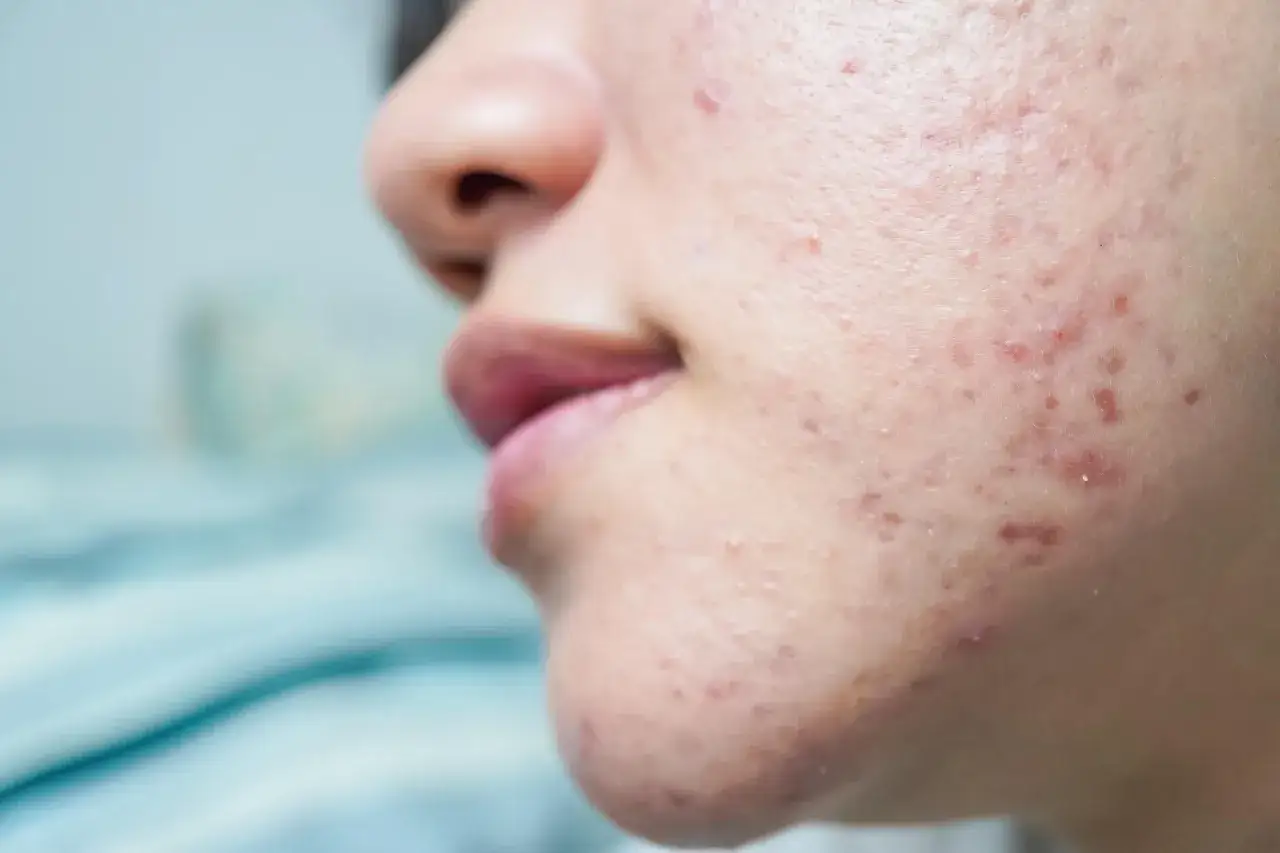 Gros plan sur le visage d'une personne présentant une acné hormonale. Recherche d'un traitement naturel pour apaiser la peau.