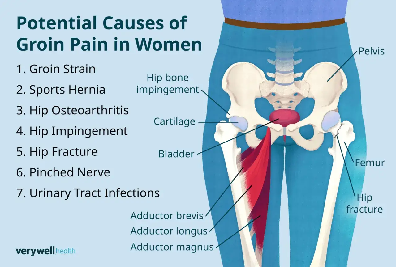 Anatomie féminine montrant le bassin, le fémur et les muscles adducteurs. Une douleur au muscle pectiné chez la femme peut être causée par plusieurs facteurs.