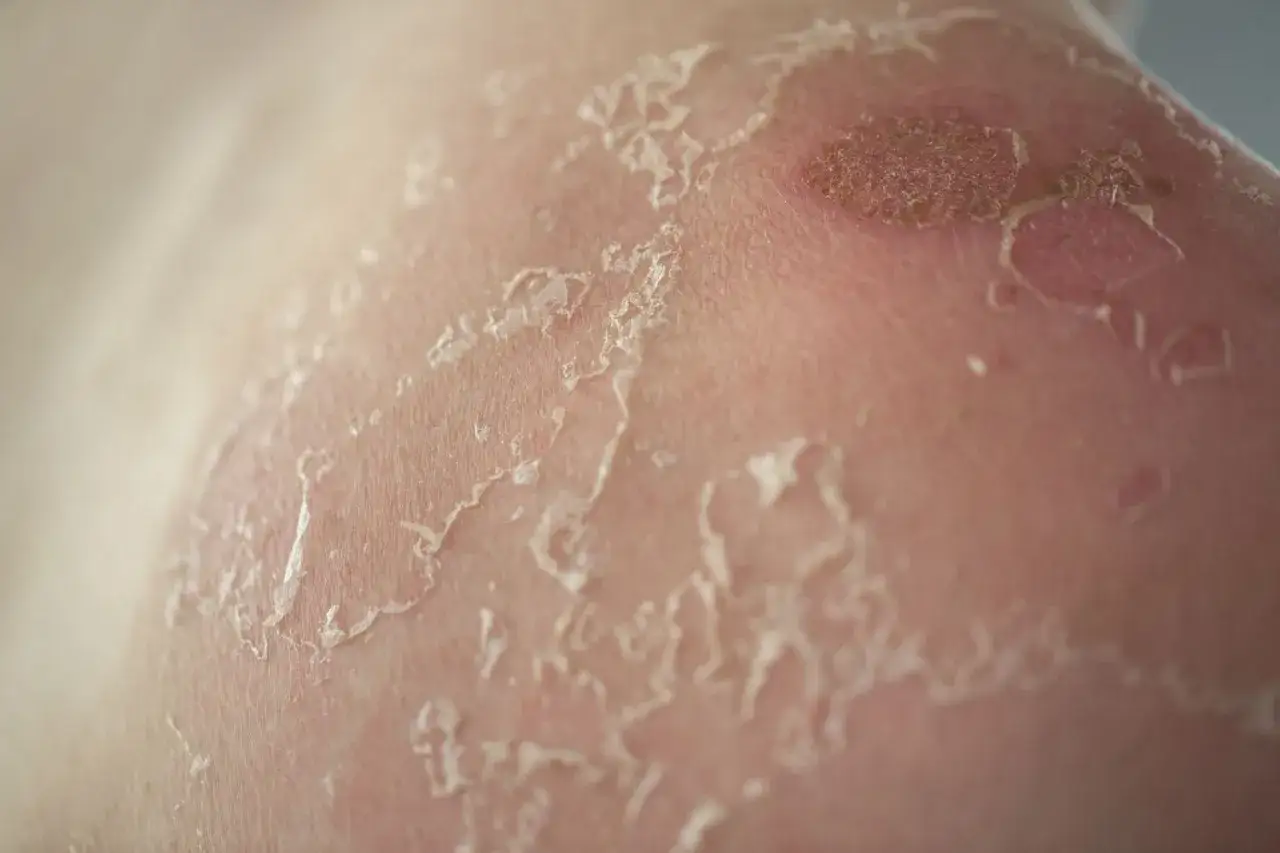 Gros plan sur une peau rouge et irritée, montrant des lambeaux de peau qui pèle, signe d'un coup de soleil.