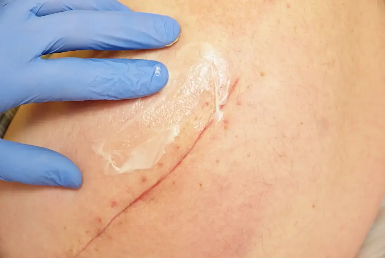 Main d'une personne portant un gant bleu appliquant une crème sur une peau lésée avec une cicatrice.