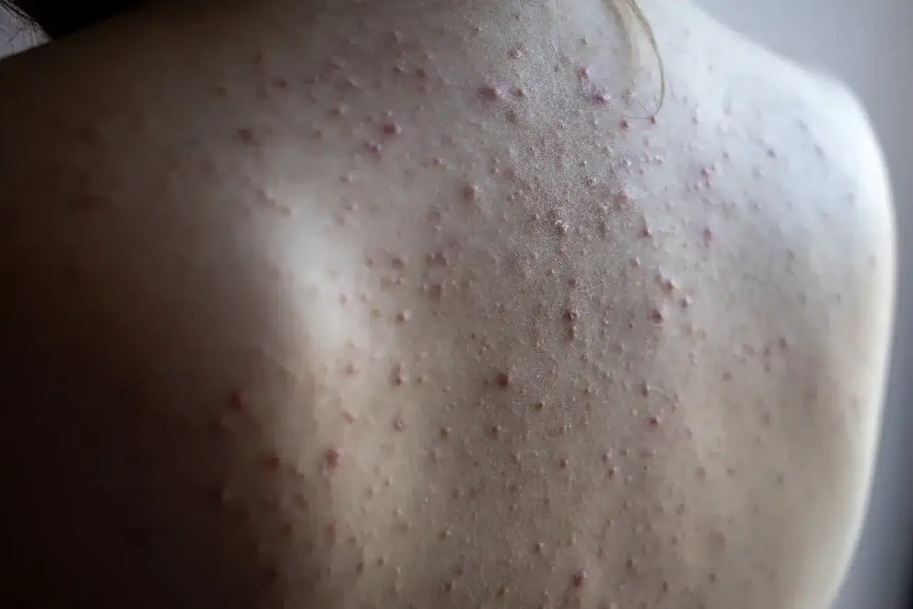 Gros plan sur le dos d'une personne présentant de nombreuses petites imperfections rouges et blanches, typiques de l'acné du dos.