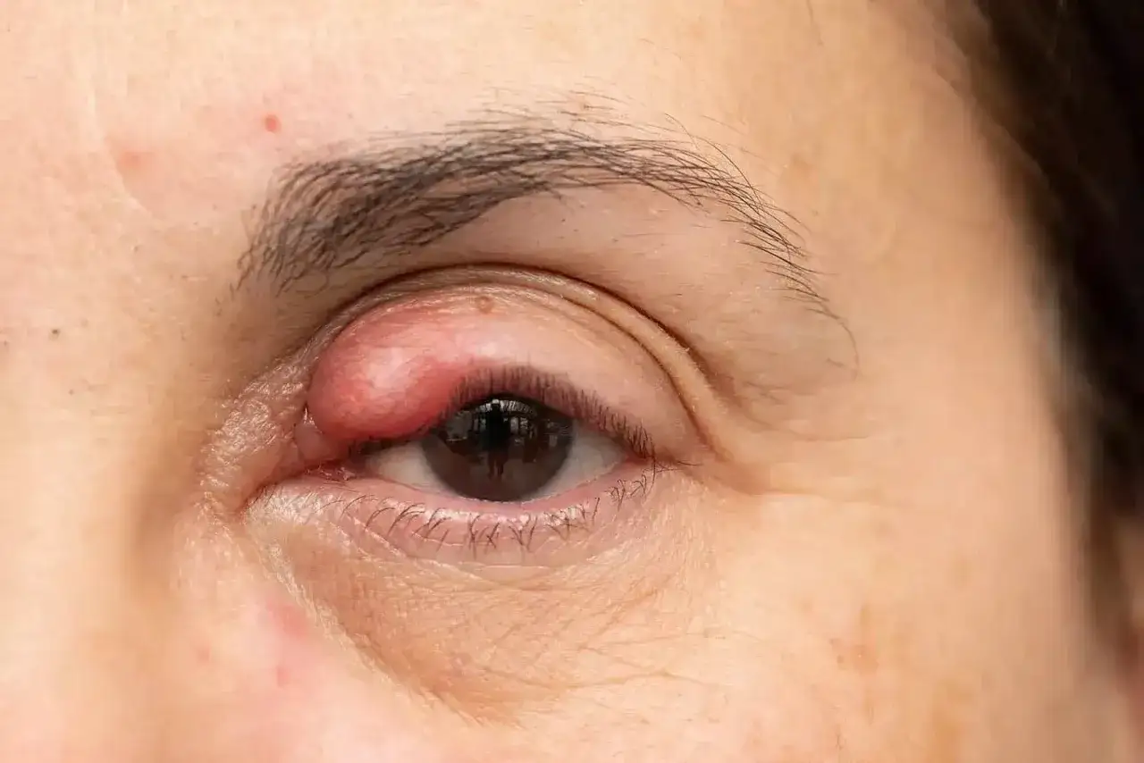 Gros plan sur un œil humain avec un bouton blanc sur la paupière supérieure, rouge et enflammé.