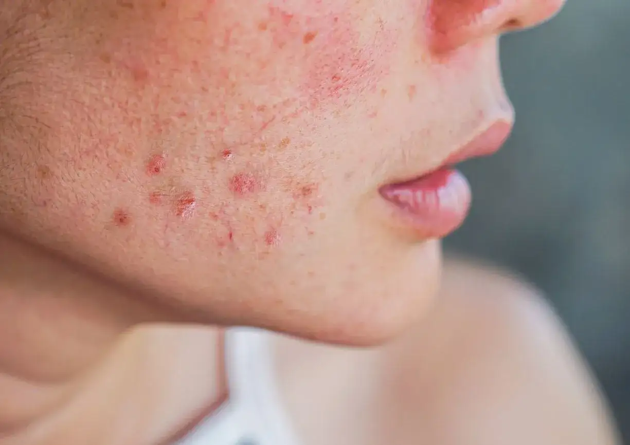 Visage marqu&eacute; par des rougeurs et des boutons d'acn&eacute;. On cherche un rem&egrave;de de grand-m&egrave;re pour effacer les cicatrices et retrouver une peau lisse.
