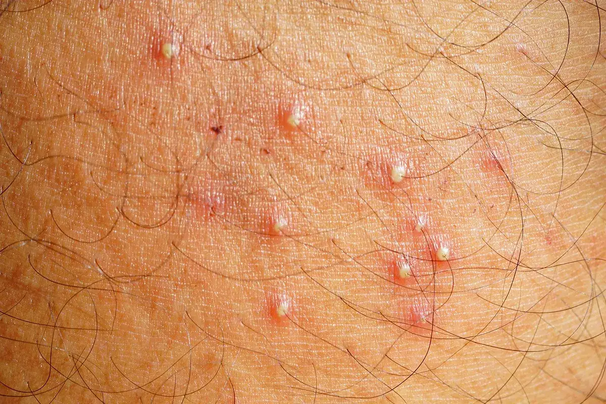 Gros plan sur une peau avec plusieurs petits boutons rouges et blancs, certains contenant du pus, typiques d'un poil incarn&eacute;.