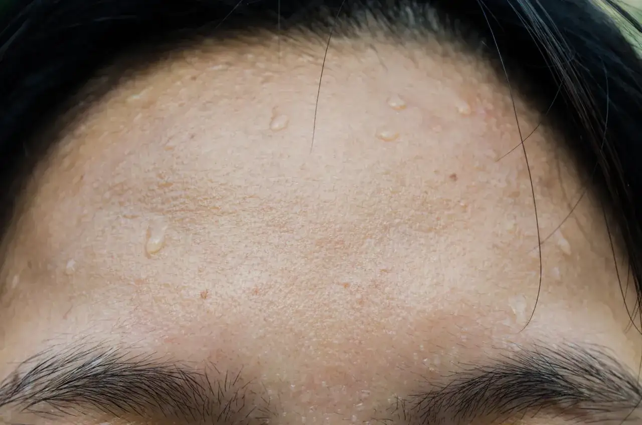 Gouttes de sueur sur le front, signe de transpiration excessive du visage. Les sourcils et quelques cheveux noirs sont visibles.