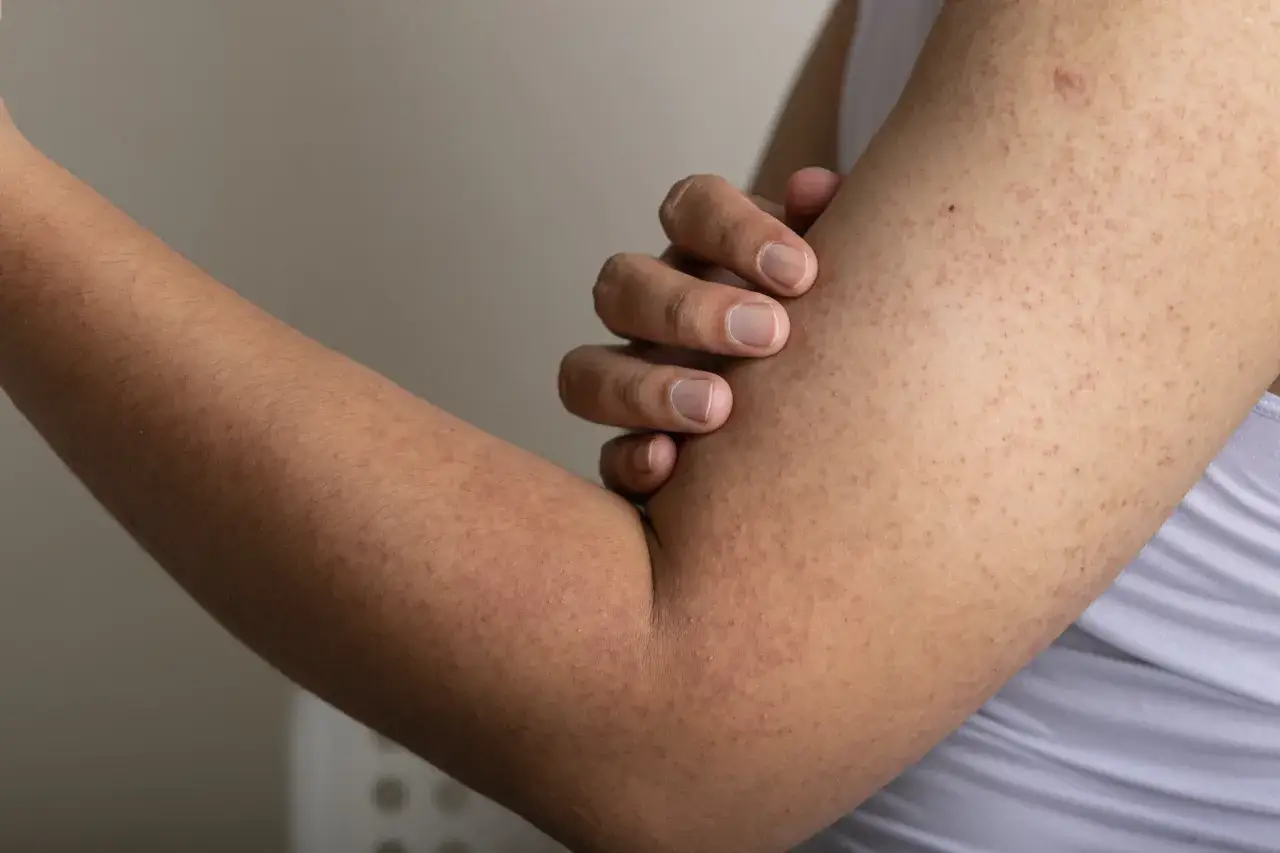 Gros plan sur un bras pr&eacute;sentant des petites bosses rouges et rugueuses, typiques de la k&eacute;ratose pilaire.