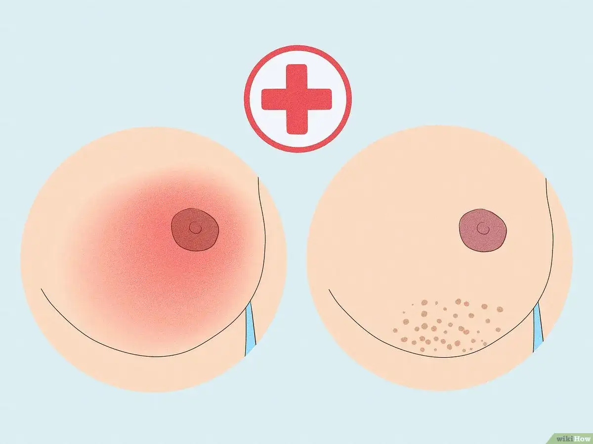 Comparaison de deux seins : l'un rouge et irrité, l'autre avec des points, peut-être un téton qui gratte.