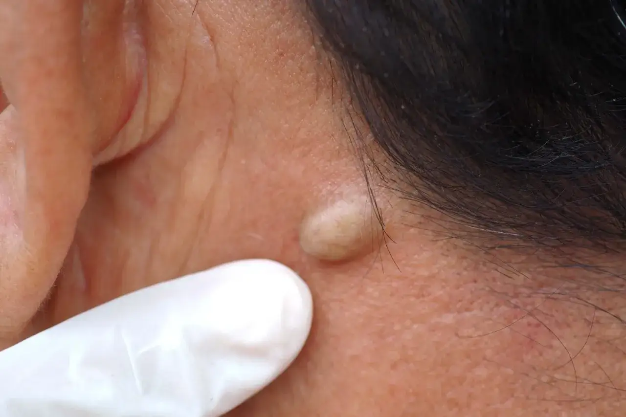 Gros plan sur un micro kyste sur le visage, pr&egrave;s de l'oreille. Un doigt gant&eacute; blanc examine la petite protub&eacute;rance cutan&eacute;e.