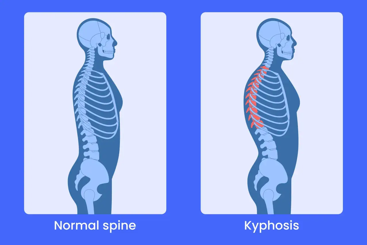 Comparaison de la colonne vert&eacute;brale : une posture normale et une cyphose dorsale accentu&eacute;e, o&ugrave; le dos est courb&eacute;.
