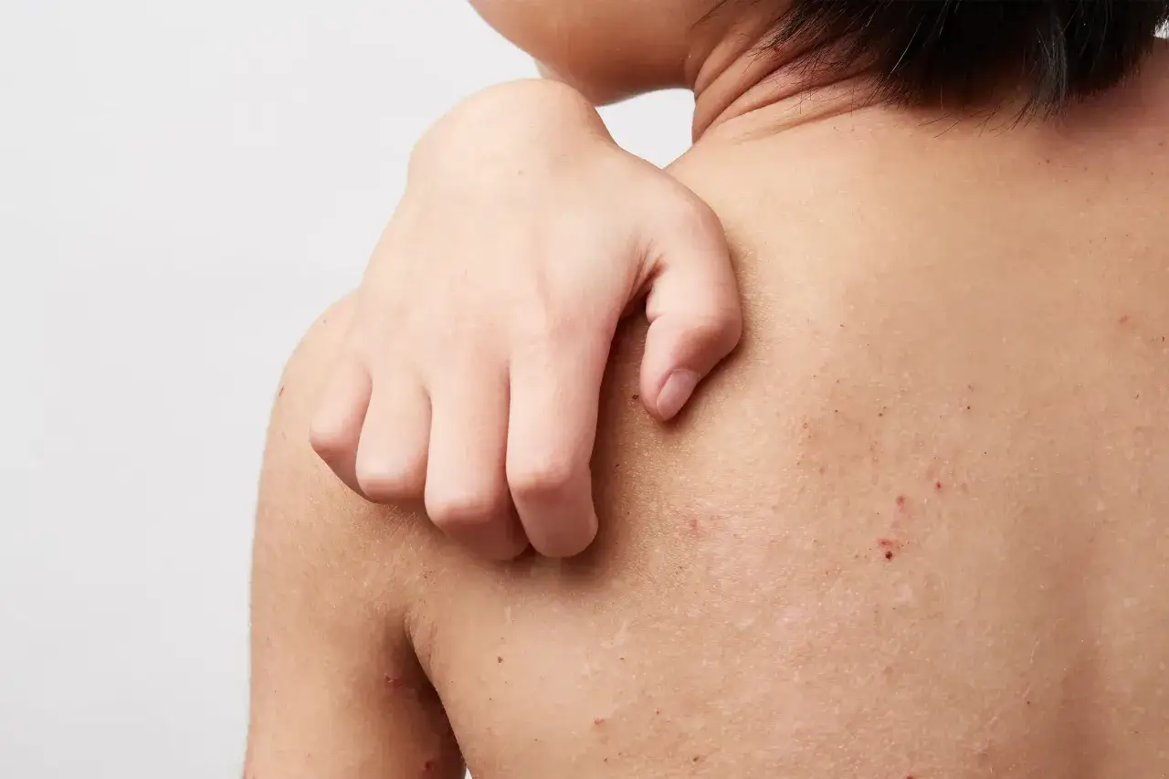 Une main se gratte le dos, r&eacute;v&eacute;lant des rougeurs et des marques sugg&eacute;rant de l'ecz&eacute;ma.
