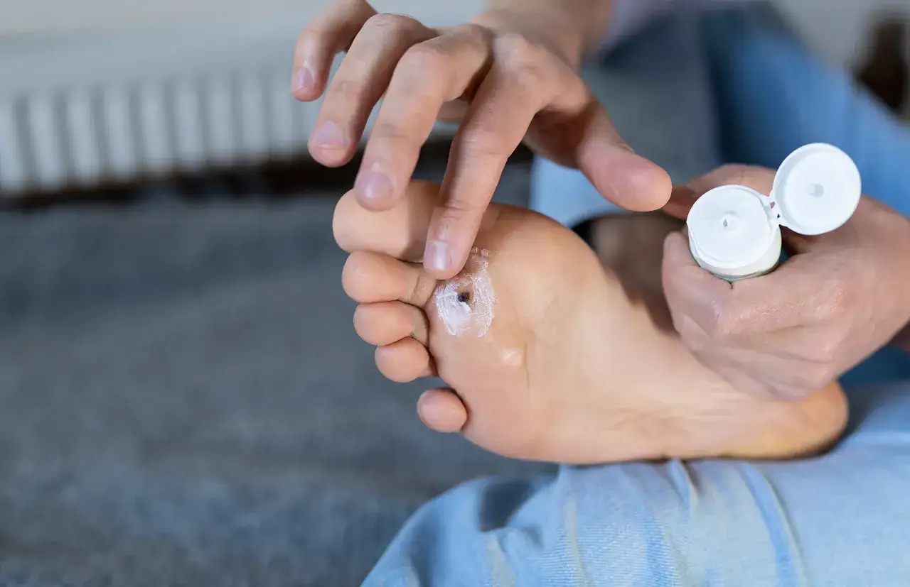 Application d'une crème à l'acide salicylique sur une verrue plantaire.