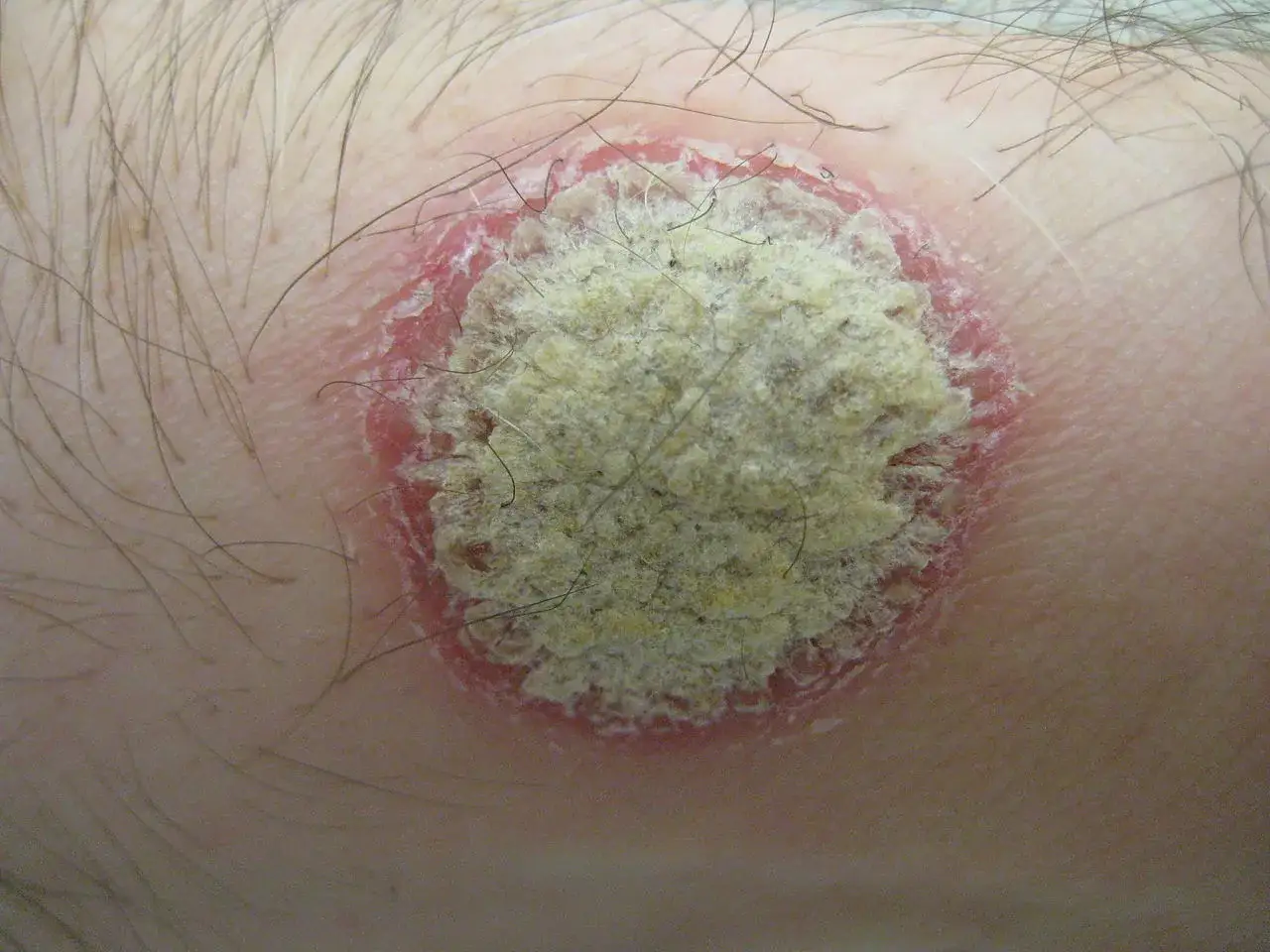 Plaque circulaire sur la peau, rouge et squameuse, ressemblant à un petit bouton sur le ventre qui ne gratte pas.