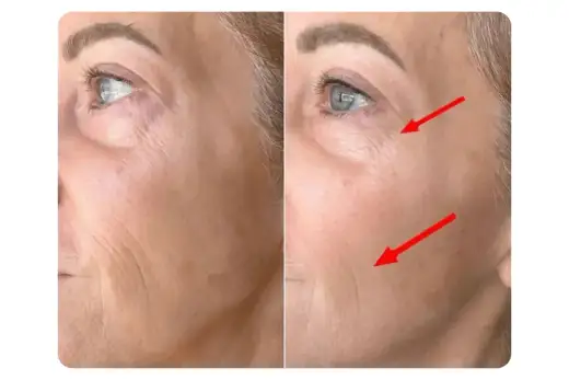 Masque LED visage avant après - les vrais délais et résultats