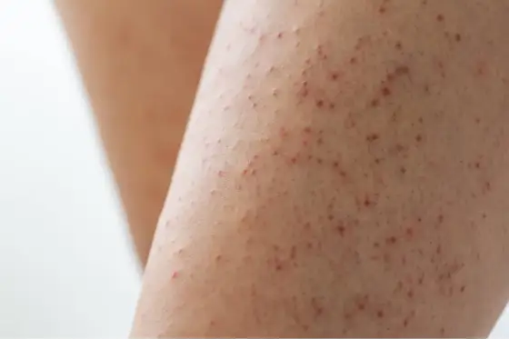 Kératose pilaire - comment apaiser la peau sans l'agresser