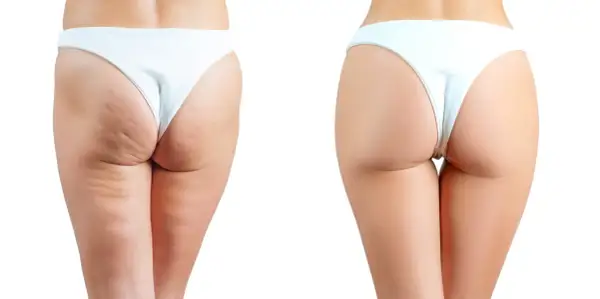 Comparaison avant/après : les fesses présentent une peau lisse et ferme, sans cellulite.