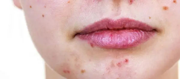 Gros plan sur une bouche et un menton présentant des rougeurs et des micro kystes sur le visage.
