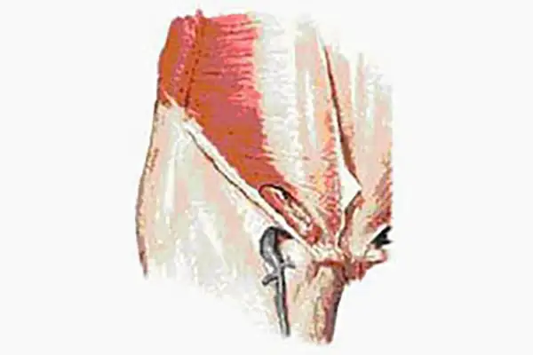 Illustration anatomique montrant le muscle pectiné, source potentielle de douleur chez la femme.