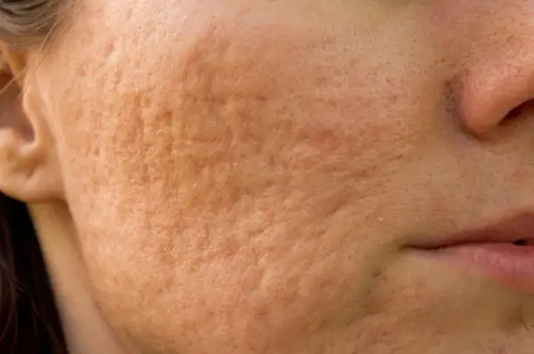 Gros plan sur une joue présentant une peau granuleuse et des cicatrices d'acné, révélant une texture irrégulière.