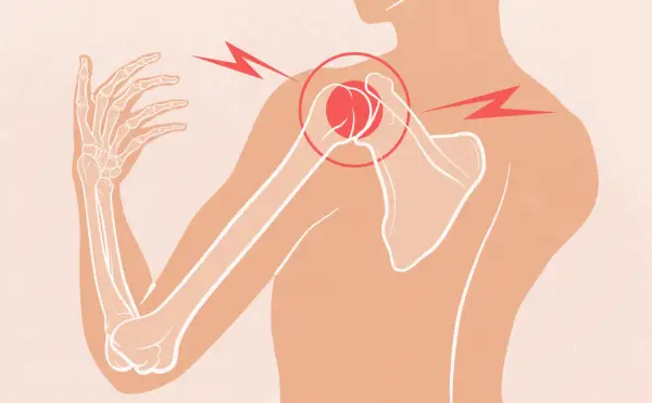 Douleur vive à l'épaule et au dos, le muscle tendu irradie. Le squelette de l'épaule est mis en évidence.