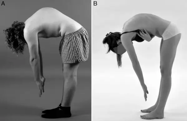Deux individus se penchent en avant. L'image A montre une cyphose dorsale normale chez un homme. L'image B montre une posture similaire chez une femme.