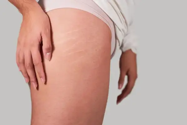 Gros plan sur la cuisse d'une personne, montrant des vergetures. La peau est légèrement rosée, avec des marques blanches caractéristiques des vergetures sur la cuisse.