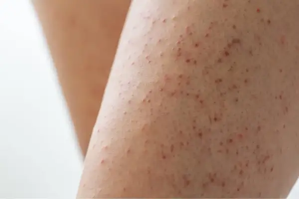 Gros plan sur une peau présentant de petites bosses rouges, typiques de la kératose pilaire.