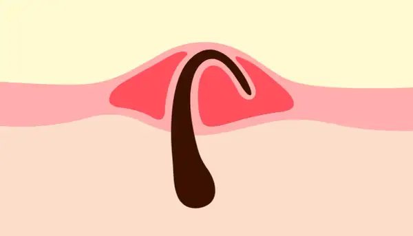 Illustration d'un poil incarné sous la peau, avec une partie sombre courbée sous une couche rouge.