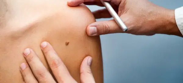 Un médecin examine un grain de beauté qui saigne sur l'épaule d'un patient.