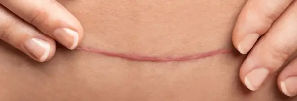 Des doigts écartent la peau pour révéler une cicatrice rosée. Un remède de grand-mère pour effacer les cicatrices, un espoir de guérison.