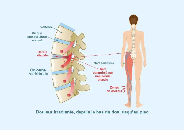 Schéma montrant une hernie discale comprimant le nerf sciatique, causant douleur irradiante dans le muscle fessier et la jambe.