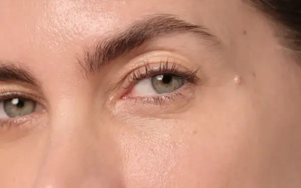 Gros plan sur un œil, montrant une peau claire avec une légère rougeur et une petite lésion, possiblement un psoriasis paupière.