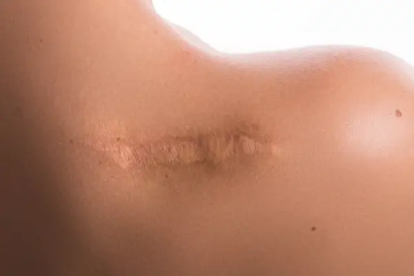 Gros plan sur une épaule avec une cicatrice visible, témoignant d'une peau lésée qui a guéri.