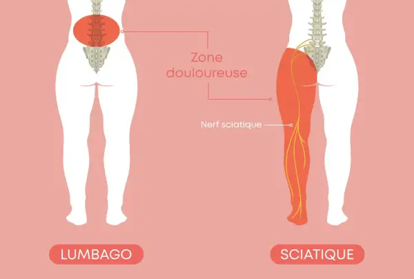 L'image illustre le lumbago et la sciatique, montrant une douleur le long de la colonne vertébrale et irradiant dans la jambe via le nerf sciatique.